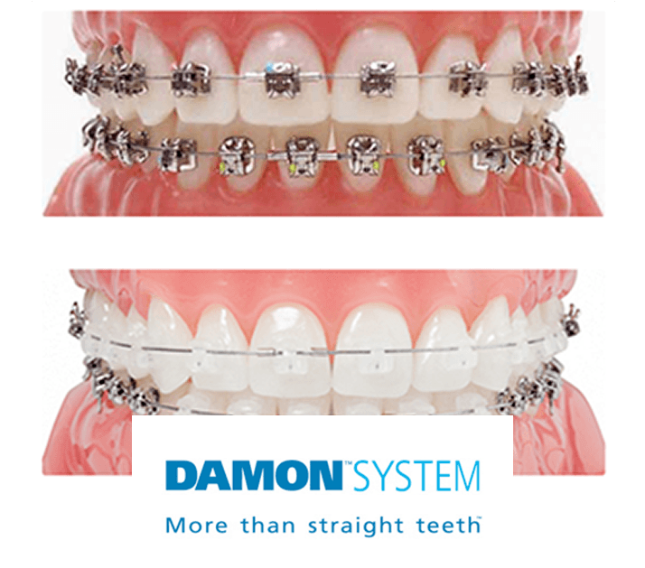 damon braces system