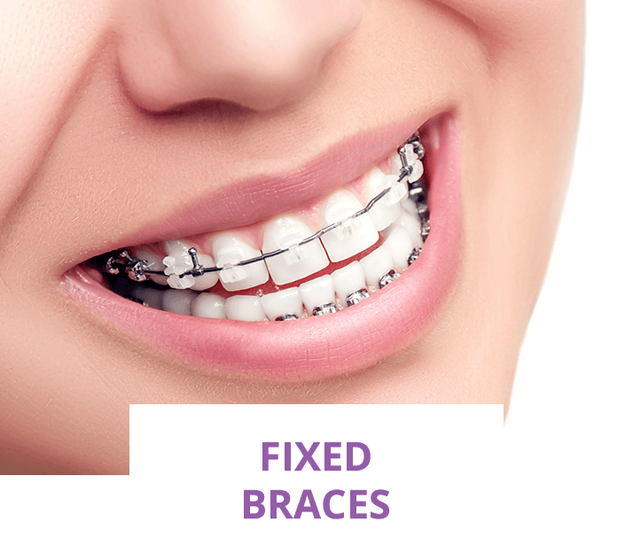 fixed braces