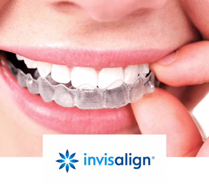 Braces Derby Invisalign Invisible Clear Braces, Damon, Incognito