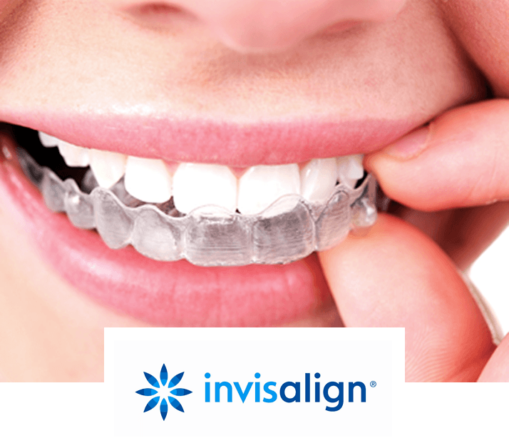 invisalign