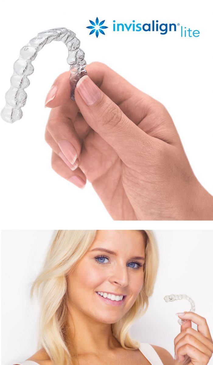 Invisalign Lite Uses Invisible Clear Braces For Minor Teeth Straightening Derby Park Brace Clinic