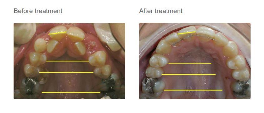 damon braces