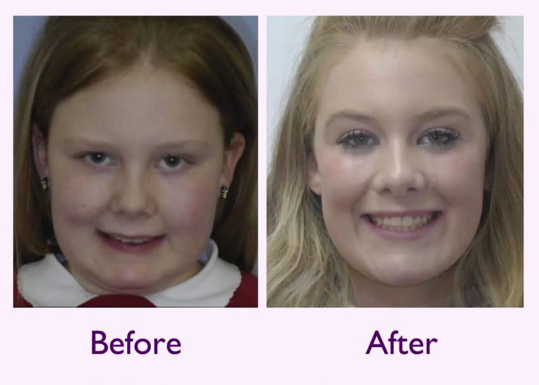 Fixed Braces Derby Cheap Ceramic or Metal Orthodontic Braces for Kids