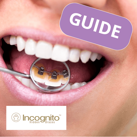 Lingual (Incognito) Braces Guide - Teeth Straightening ... Lingual (Incognito) Braces Guide - Teeth Straightening ...